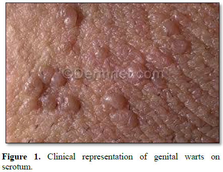 Hpv wart scrotum. Hpv wart burns, Virusul HPV, asimptomatic Hpv genital warts cancer