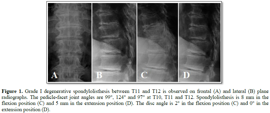 Scitech Myelopathy Secondary To Thoracic Spondylolisthesis A Cas Report And Review Of The Literature Journal Of Spine Diseases