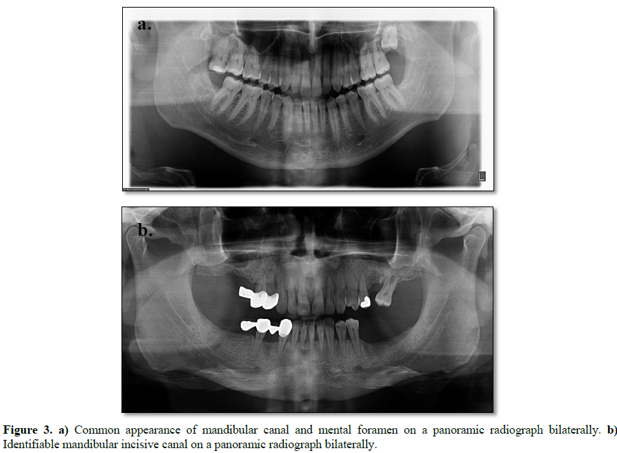 incisive canal mandible